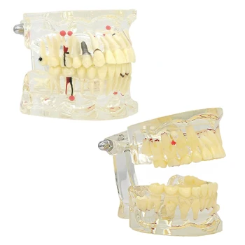 Модель патологических зубов с разборными моделями зубов для взрослых и детей, модель стоматологии для студенческой учебной демонстрации
