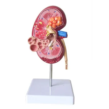 Модель Пораженной Почки Анатомический Орган Человека Медицинские Учебные Принадлежности